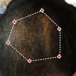 Top down view before image of a man with thinning hair at the frontal region of his hair.