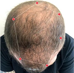 Top down view before image of a man with thinning hair at his crown.