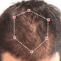 Top down view before image of a man with thinning hair at the frontal region of his hair.