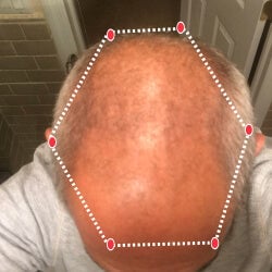 Top down view before image of a man with thinning hair at the crown and frontal region of his hair.