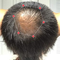 Top down view before image of a man with a thinning hair in his crown.