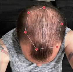 Top down view before image of a man with thinning hair at his crown.