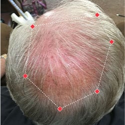 Top down view before image of a man with a thinning hair in his crown.