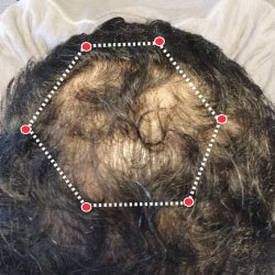 Top down view before image of a man with a bald spot at his crown.