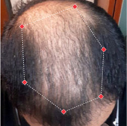 Top down view before image of a man with thinning hair at the crown and frontal region of his hair.