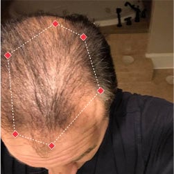 Top down view before image of a man with thinning hair at the crown and frontal region of his hair.
