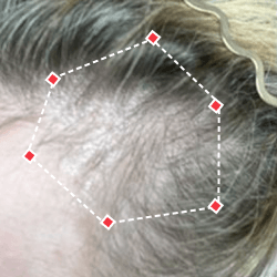 Before image of a woman showing the thinning hair at her temples.