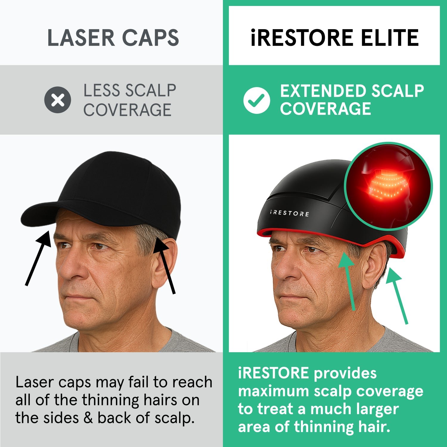 An image comparing the iRESTORE Elite with other laser cap. Laser caps only have less scalp coverage, laser caps may fail to reach all of the thinning hairs on the sides and back of scalp. While the Elite device have extended scalp coverage. it provides maximum scalp coverage to treat a much larger area of thinning hair.