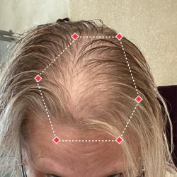 Top down view after image of a woman showing a more thicker hair at the frontal region of her hair.
