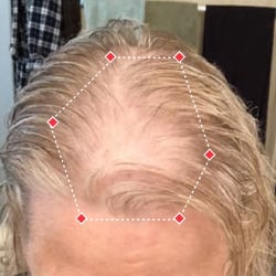 Top down view before image of a woman with bald spot at the frontal region of her hair.