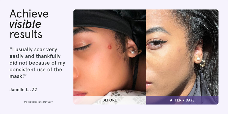 Achieve visible results. Before and after comparison of a woman's acne on cheek showing skin improvement after 7 days. I usually scar very easily and thankfully did not because of my consistent use of the Mask! Janelle L., 32. Individual results may vary.