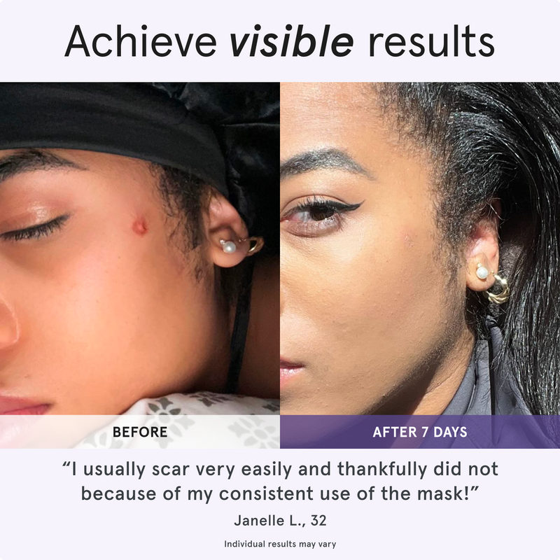 Achieve visible results. Before and after comparison of a woman's acne on cheek showing skin improvement after 7 days. I usually scar very easily and thankfully did not because of my consistent use of the Mask! Janelle L., 32. Individual results may vary.