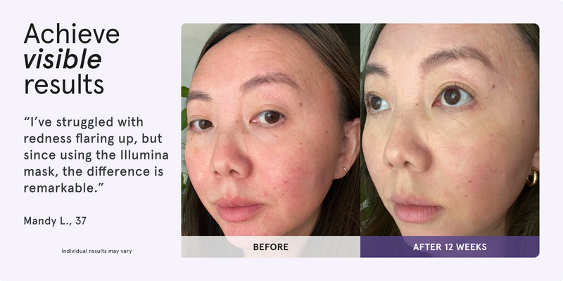 Achieve visible results. Before and after comparison of a woman's face showing reduced redness after 12 weeks. I've struggled with redness flaring up, but since using the Illumina mask, the difference is remarkable. Mandy L., 37. Individual results may vary.