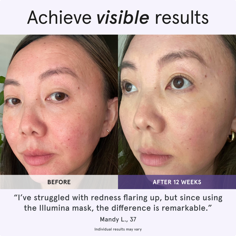 Achieve visible results. Before and after comparison of a woman's face showing reduced redness after 12 weeks. I've struggled with redness flaring up, but since using the Illumina mask, the difference is remarkable. Mandy L., 37. Individual results may vary.