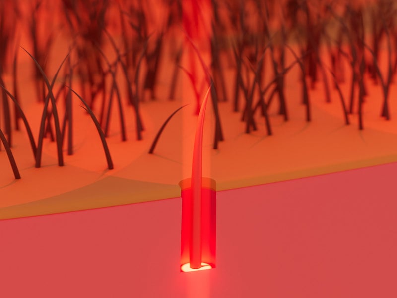 3D image of laser beam penetrating on scalp.