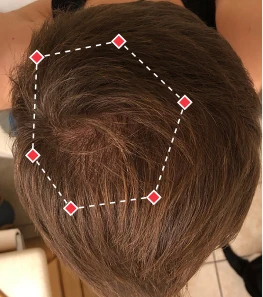 after image showing improved hair density