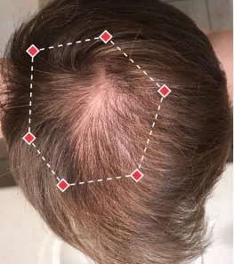 before image showing hair loss