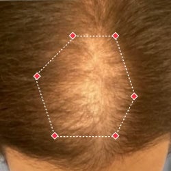 Top down view before image of a woman with bald spot at the frontal region of her hair.
