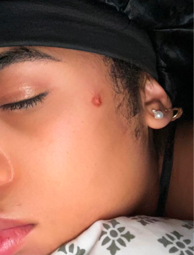 Side view before image of woman with acne and blemishes