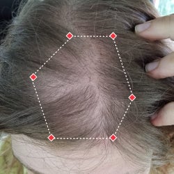 Top down view before image of a woman with bald spot at the frontal region of her hair.