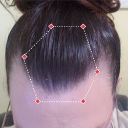 Top down view before image of a woman with thinning hair at the frontal region of her hair.