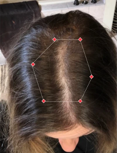 Top down view after image of a woman showing her hairline with growing more her that fills the gab between her hairline. 