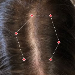 Top down view after image of a woman showing her hairline with growing more hair that fills the gap between her hairline. 