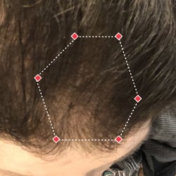Top down view after image of a woman showing a more thicker hair at the frontal region of her hair.