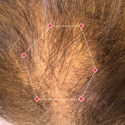 Top down view before image of a woman with bald spot at the frontal region of her hair.