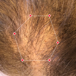 Top down view before image of a woman with bald spot at the frontal region of her hair.