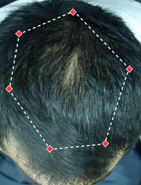 Top down view after image of a man with thicker hair at the frontal region of his hair.