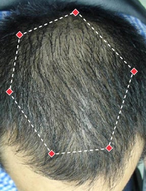 Top down view before image of a man with thinning hair at the crown and frontal region of his hair.