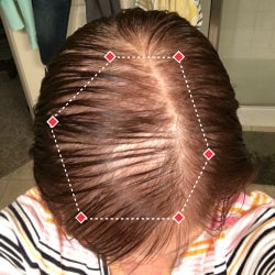 Top down view before image of a woman with thinning hair at the frontal region of her hair.