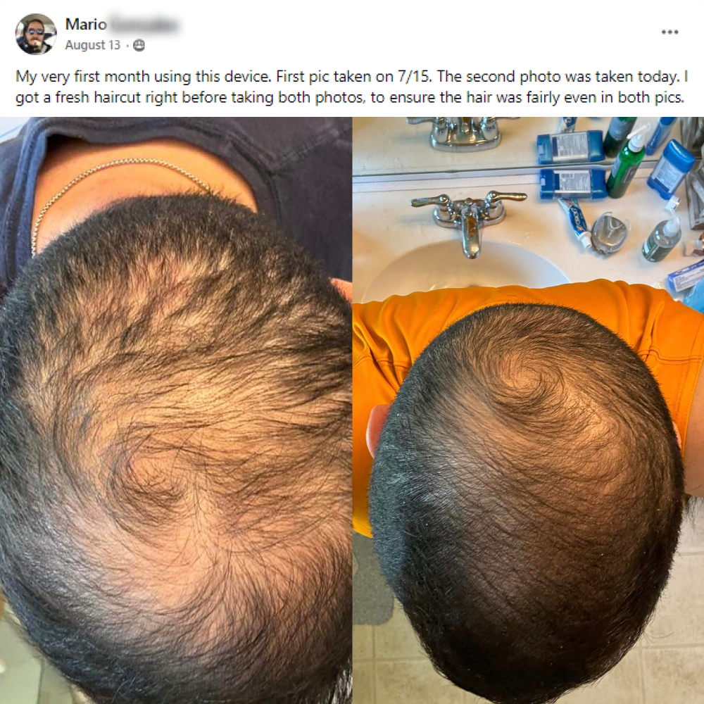 A facebook post from Mario on August 13th. My very first month using this device. First pic taken on July 15. The second photo was taken today. I got a fresh haircut right before taking both photos, to ensure the hair was fairly even in both pics. This post shows before and after images with the before showing a thinning crown of a man and the after showing his crown with thicker hair.