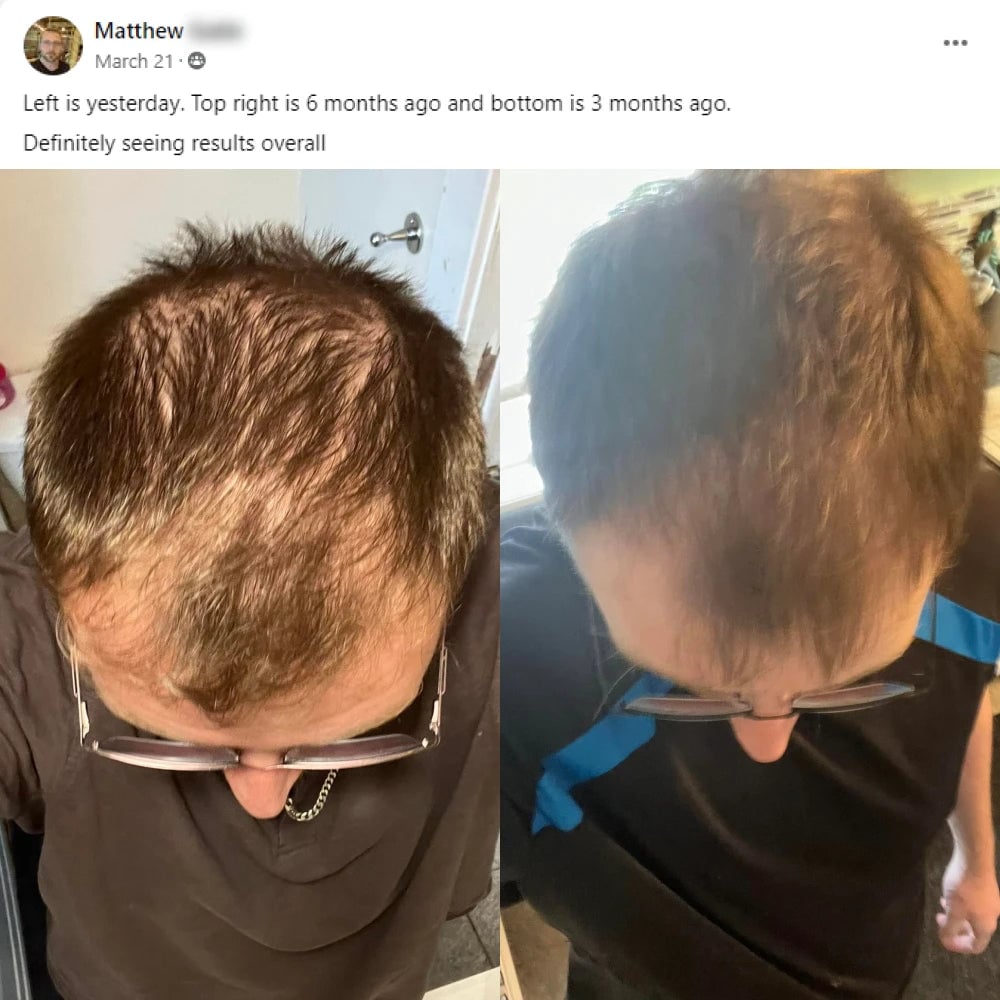 A facebook post from Matthew on March 12th. Left is yesterday, top right is 6 months ago and bottom is 3 months ago. Definitely seeing results overall. This post shows before and after images with the before showing a thinning crown of a man and the after showing the crown with thicker hair.