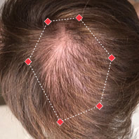 Before Image of a man from top down view at crown with thinning hair.