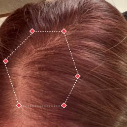Top down view after image of a woman showing her hairline with growing more hair that fills the gap between her hairline. 