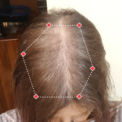 Top down view before image of a woman with thinning hair at the frontal region of her hair.