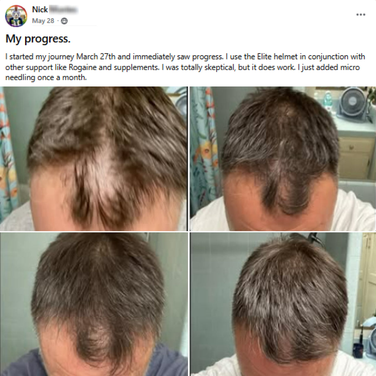 A social media testimonial post by Nick showing four progress photos of hair regrowth on his scalp after using an Elite helmet, Rogaine, supplements, and microneedling.