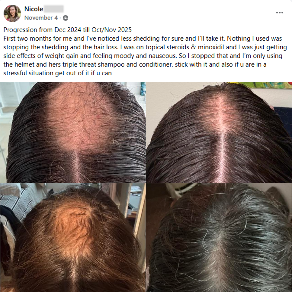 FB post showing progression of hair loss. Progression from Dec 2024 till Oct/Nov 2025
First two months for me and I’ve noticed less shedding for sure and I’ll take it. Nothing I used was stopping the shedding and the hair loss. I was on topical steroids & minoxidil and I was just getting side effects of weight gain and feeling moody and nauseous. So I stopped that and I’m only using the helmet and hers triple threat shampoo and conditioner. stick with it and also if u are in a stressful situation get out of