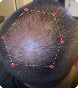Hair Growth