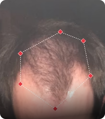 A close-up photo of a person's thinning hairline
