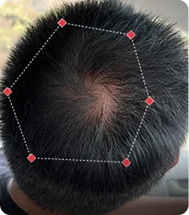 Hair Growth