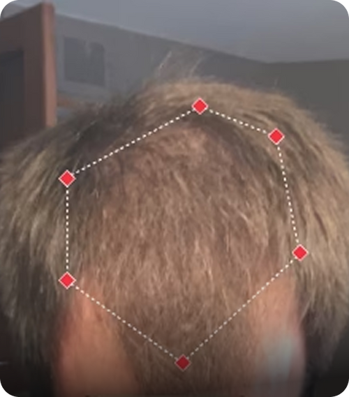 A close-up photo of a person's improving hairline
