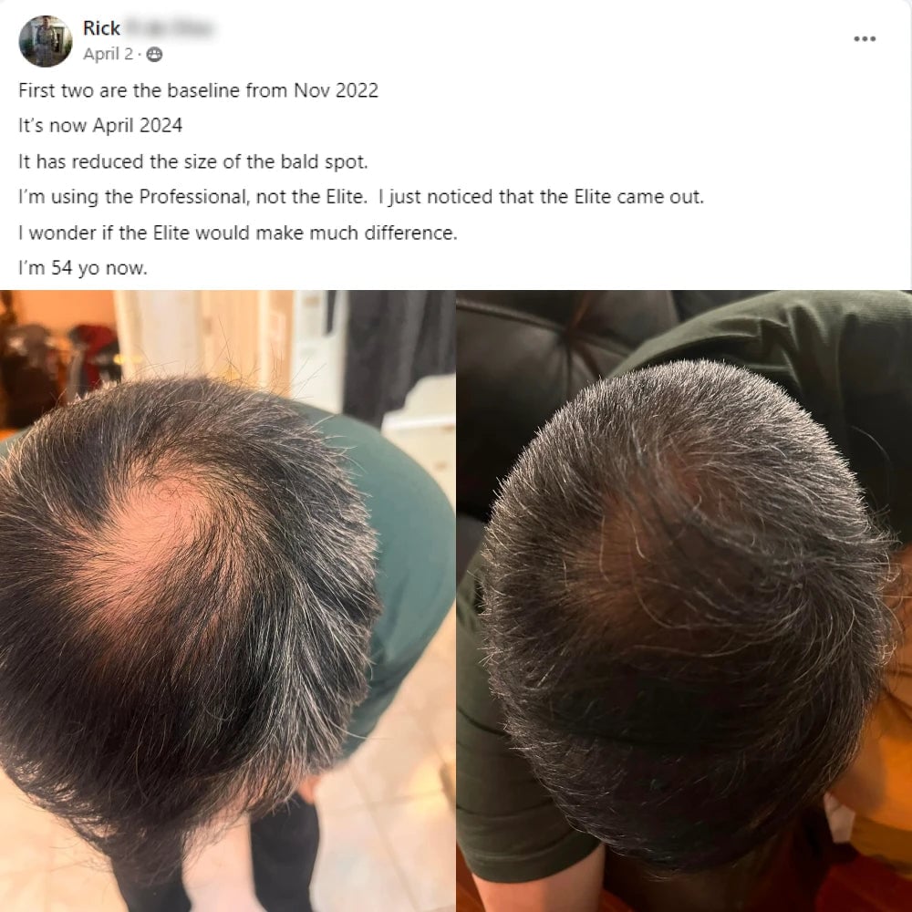 A facebook post from Rick on April 2nd. It's now April 2024, it has reduced the size of the bald spot. I'm using the Professional, not the Elite. i just noticed that the Elite came out. I wonder if the Elite would make much difference. I'm 54 years old now. This post shows before and after images with the before showing bald spot at the crown and the after showing the crown of the hair starts to fill in.