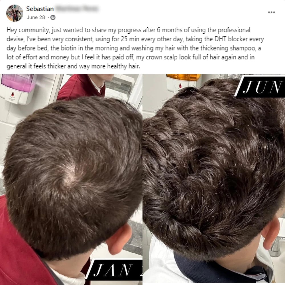 A facebook post from Sebastian on June 28th. Hey community, just wanted to share my progress after 6 months of using the professional device, I've been consistent, using for 25 minutes every other day, taking the DHT blocker every day before bed, the biotin in the morning and washing my hair with the thickening shampoo, a lot of effort and money but I feel it has paid off, my crown scalp look full of hair again and in general it feels thicker and way more healthy hair.This post shows before and after images
