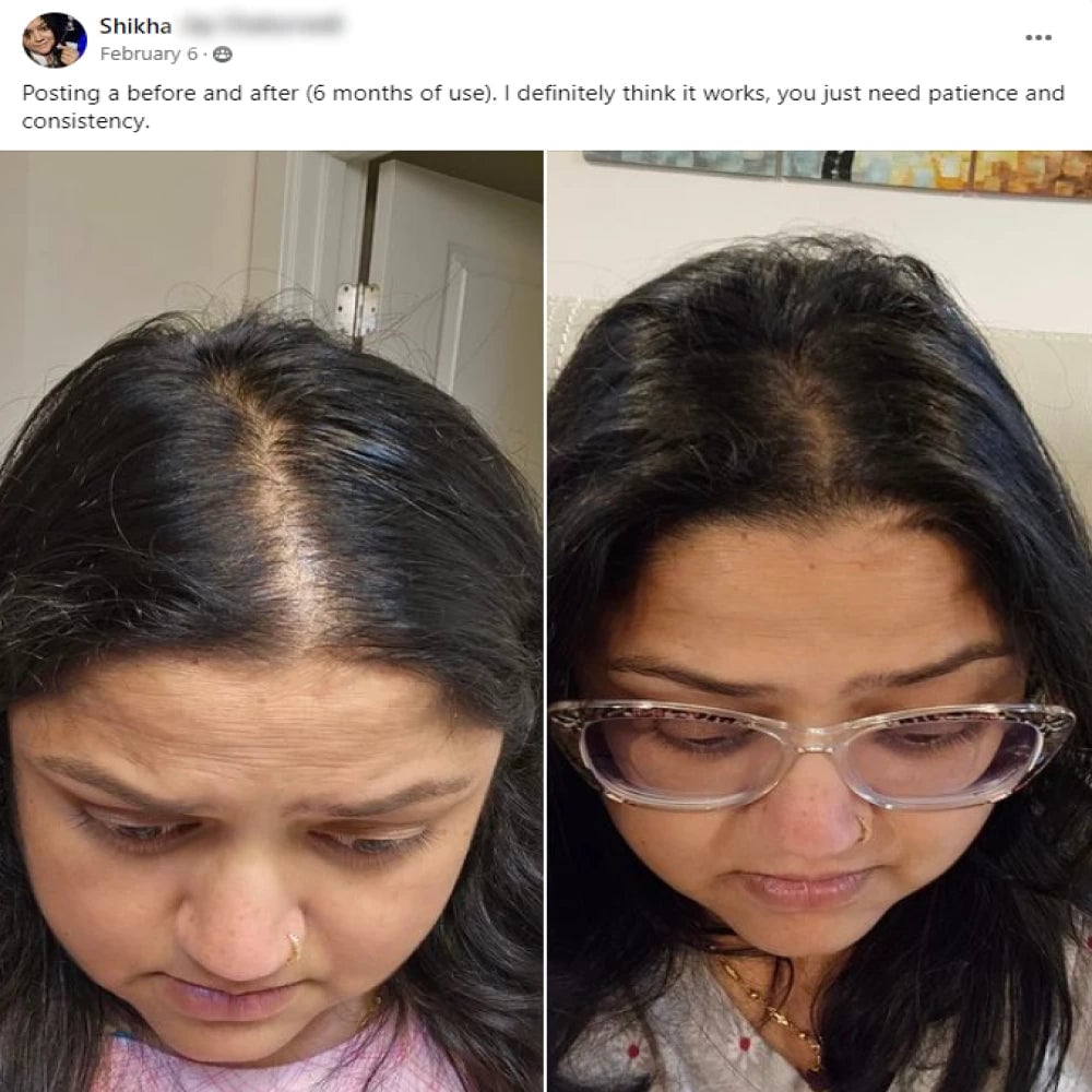 A facebook post from Shikha on February 6th. Posting a before and after 6 months of use. I definitely think it works, you just need patience and consistency. This post shows before and after images with the before showing a widening hairline of a woman and the after showing the hairline that got thicker.