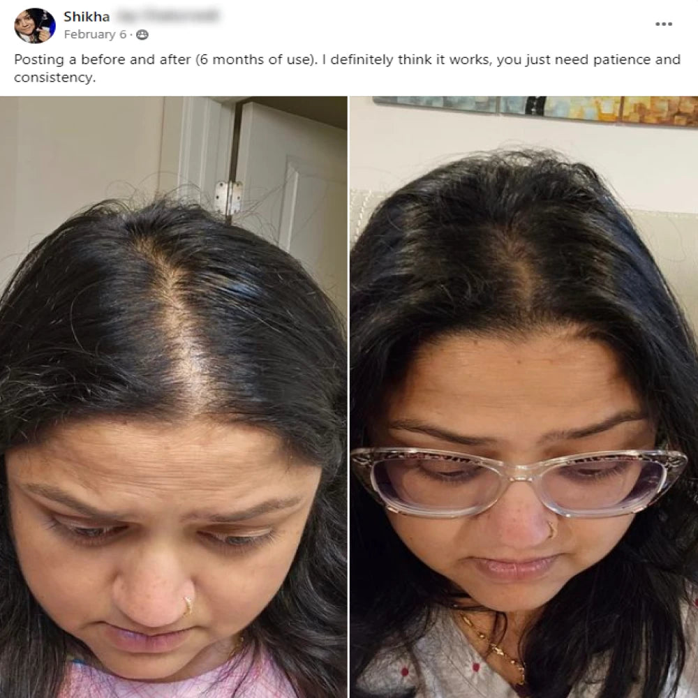 A facebook post from Shikha on February 6th. Posting a before and after 6 months of use. I definitely think it works, you just need patience and consistency. This post shows before and after images with the before showing a widening hairline of a woman and the after showing the hairline that got thicker.