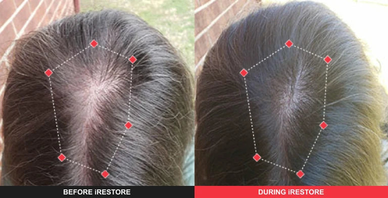 Comparison image of before and after using iRESTORE hair device