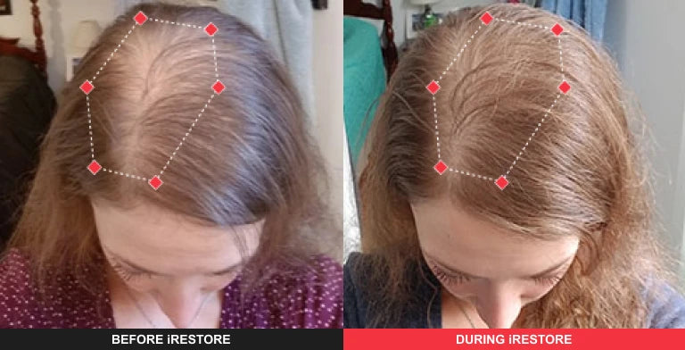 Comparison image of before and after using iRESTORE hair device
